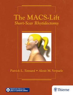 The MACS-Lift - Patrick L. Tonnard