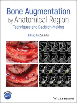 Bone Augmentation by Anatomical Region - Группа авторов