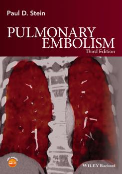 Читать Pulmonary Embolism - Paul Stein D.