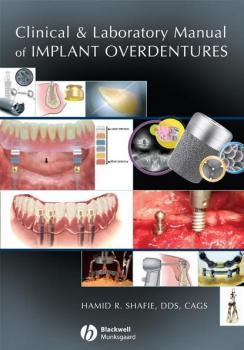 Читать Clinical and Laboratory Manual of Implant Overdentures - Группа авторов