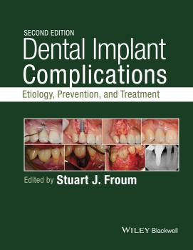 Читать Dental Implant Complications. Etiology, Prevention, and Treatment - Stuart  Froum