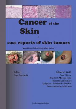 Читать Cancer of the Skin - case reports of skin tumors - Piotr Brzezinski